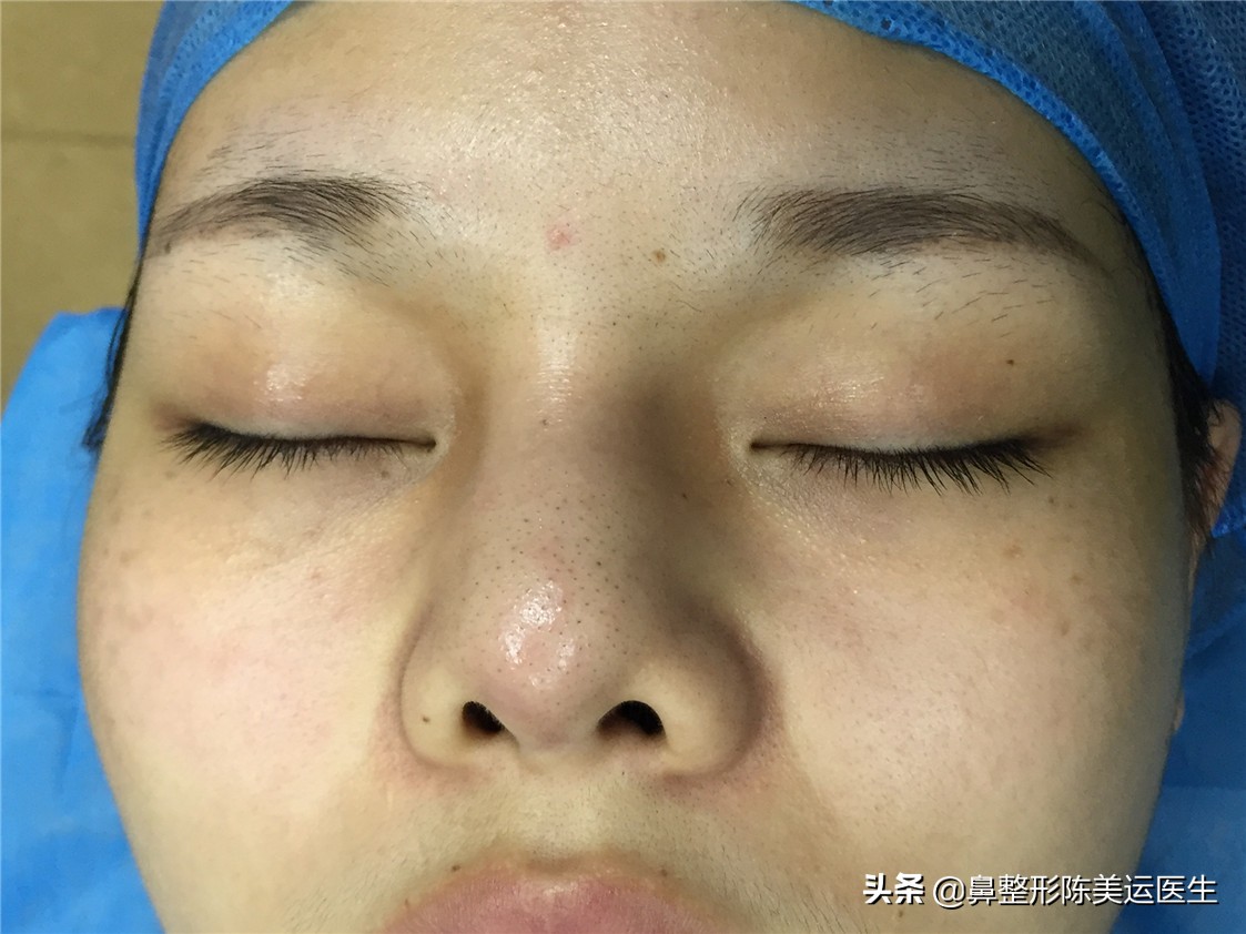 为什么医生都反对线雕隆鼻,到底要不要做线雕隆鼻