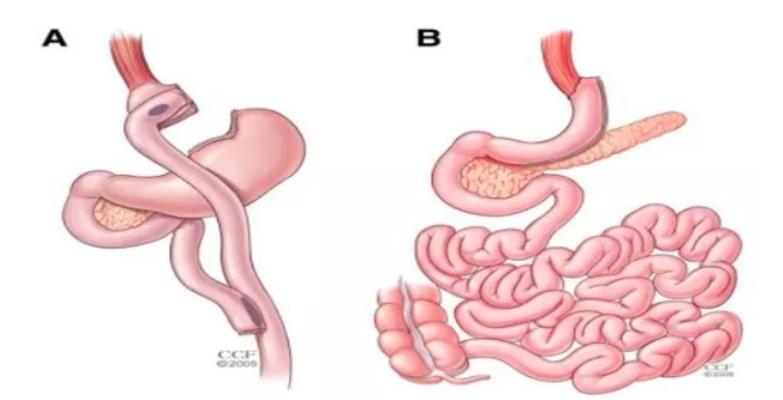 杨天真切胃后瘦了吗,杨天真做切胃手术