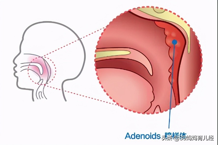 孩子张嘴睡觉会自己好吗,腺样体肥大不张嘴呼吸容易变丑吗