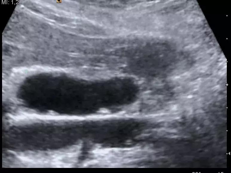 肝内多发性胆囊息肉怎么治疗,肝脏b超有问题是什么原因