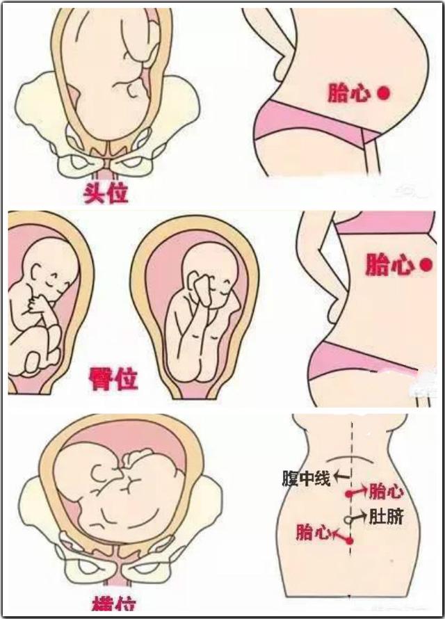孕晚期胎心在肚脐右边胎位正吗,胎心与肚脐平行是什么胎位