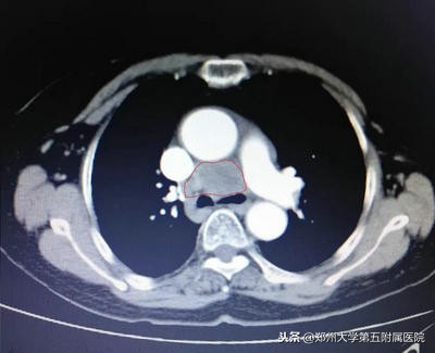 癌症脑转移伽玛刀后遗症,癌症病人接受伽玛刀治疗