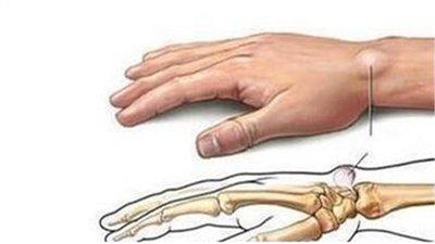 写字写多了手上有个包怎么办,手上无缘无故起个包按着很疼