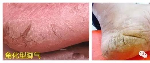 你有脚气吗健康养生,专家课堂讲治脚气