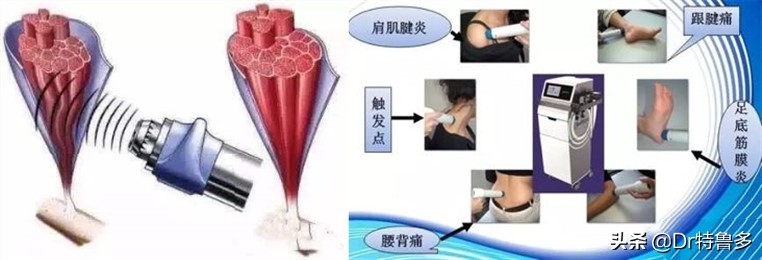 骨折久不愈合做冲击波有效吗,冲击波对骨不愈合有帮助吗