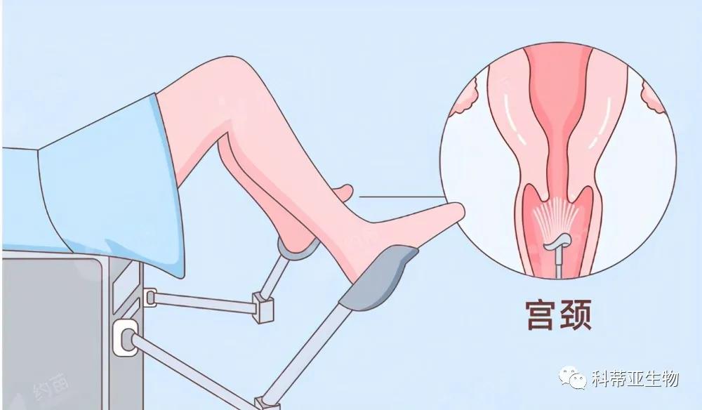 宫颈癌筛查是取哪些东西,宫颈癌筛查需要准备什么