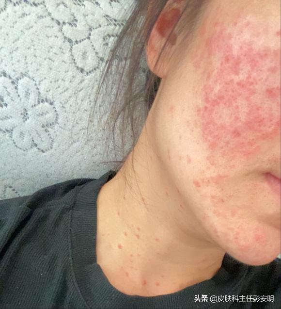 给耳朵扎针放血,耳朵上扎针放血