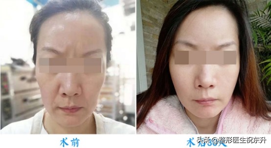 30岁皮肤松弛法令纹重怎么办,30多岁长了法令纹怎么办