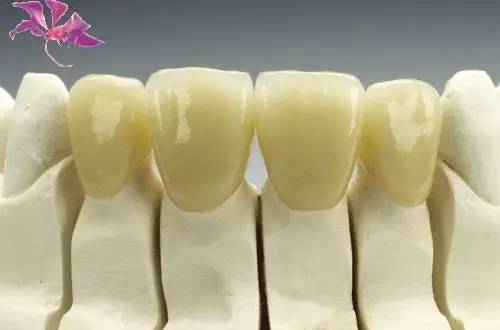 Helen齿科中心——如何选择牙套的材料？