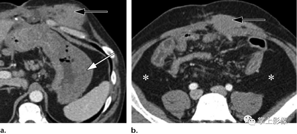 腹壁病变诊断思路,腹部影像诊断读片入门视频