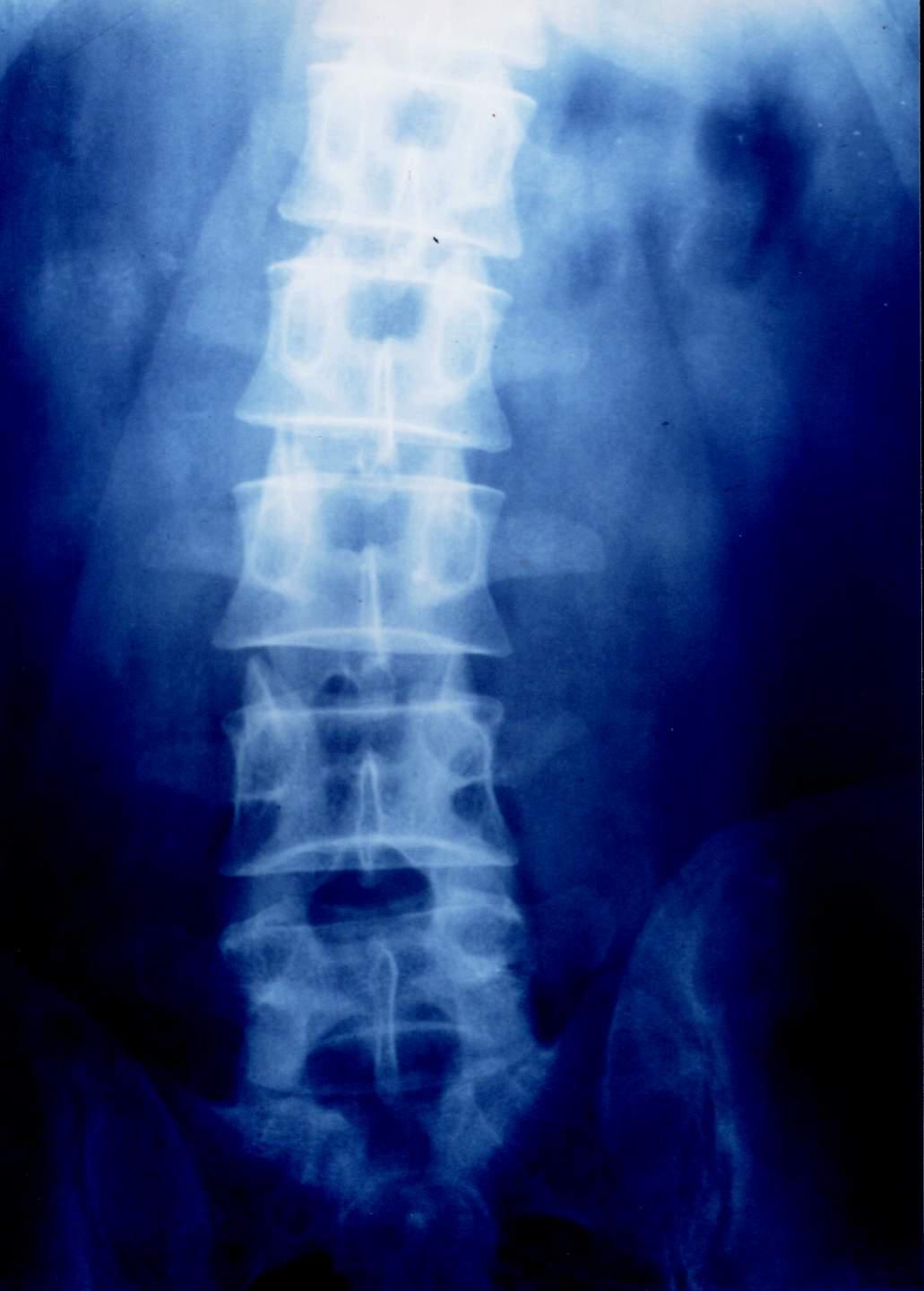 腰椎间盘突出针灸有副作用吗,腰椎间盘突出针灸越来越严重