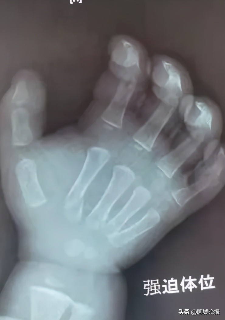 一岁多的聊城娃,牵动多地名医心