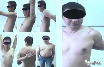 肩锁关节脱位手术后多久可以喝酒,肩锁关节脱位钢板内固定步骤记录