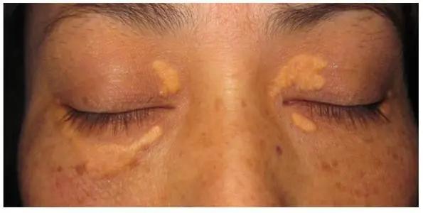 脸上浮肿与心脏有关吗,脸上长斑跟心脏有关系吗