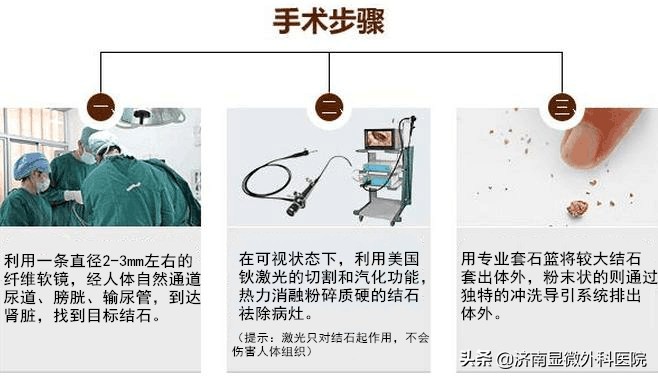 输尿管结石钬激光碎石取石,软镜取肾结石输尿管狭窄几率大吗