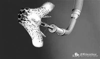 二尖瓣手术是微创还是开胸,二三尖瓣反流手术微创还是开胸