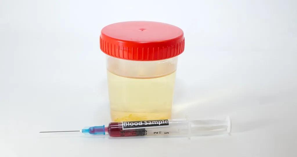 尿糖阳性是否严重,尿糖阳性血糖正常怎么回事