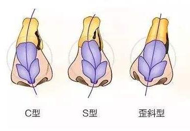 朝天鼻该怎么矫正,朝天鼻矫正最好的方法