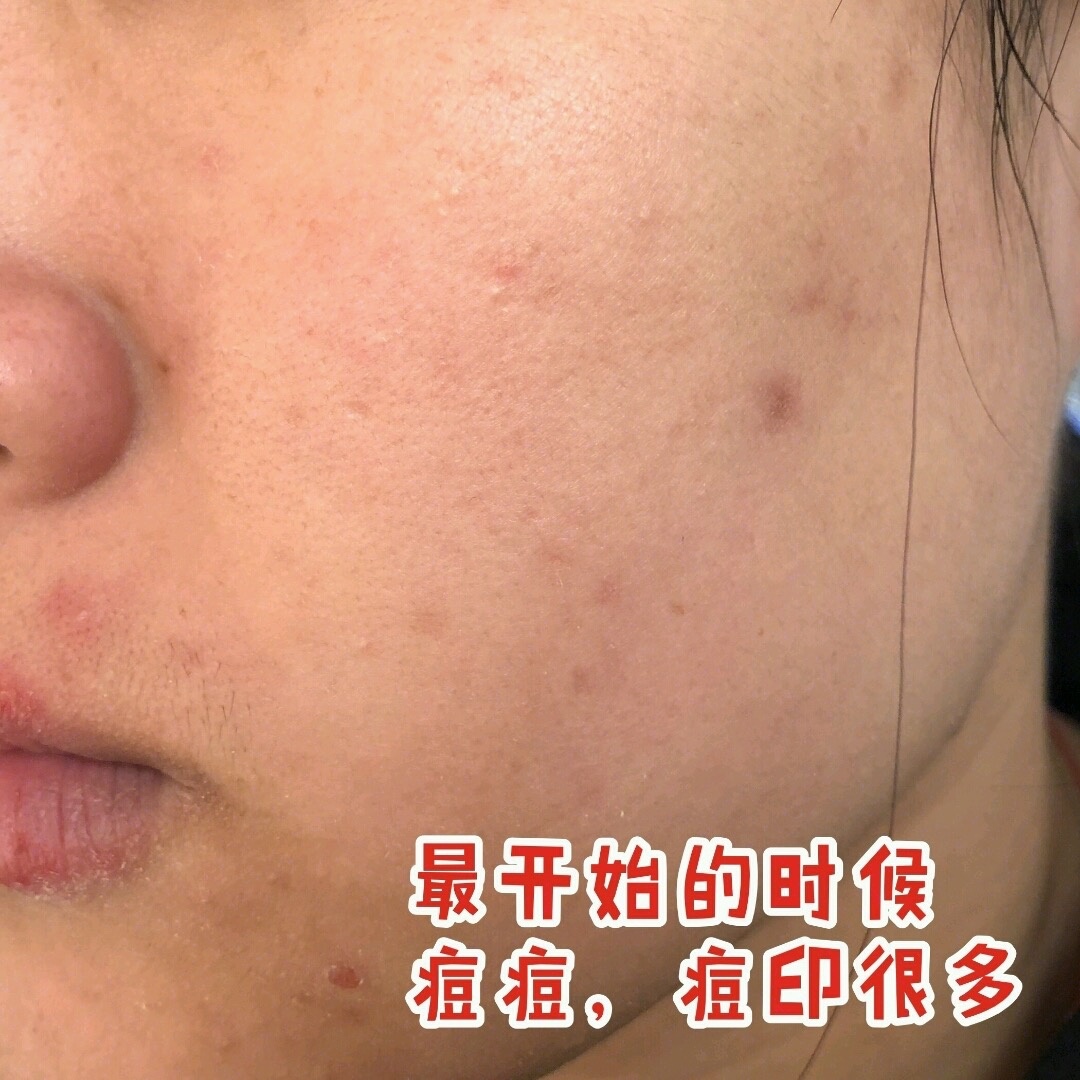 祛痘印最有效的方法排名,祛痘印淡化痘印用什么药膏
