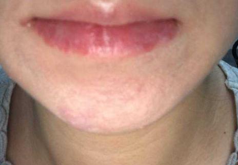 下巴反复长痘闭口粉刺用什么药膏,下巴粉刺痘痘反反复复怎么调理