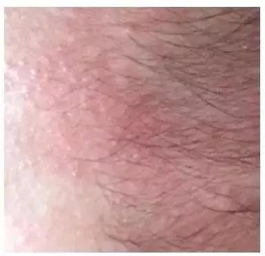 为什么湿疹疙瘩难消除,儿童湿疹抓破后难愈合怎么办