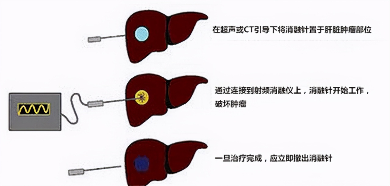 肝癌是如何确诊的？彩超能查出肝癌吗？听听专家怎么说