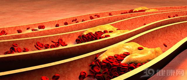 胆固醇超标怎么解决,如果胆固醇超标了会怎样