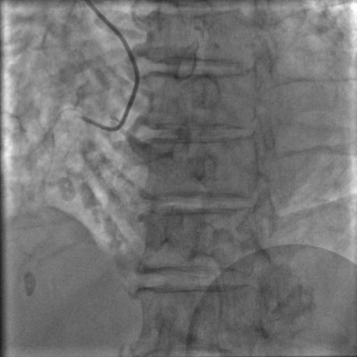 85岁老人心脏堵塞,77岁老人冠脉狭窄放支架还是搭桥