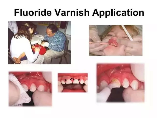 牙齿脱矿涂氟多久可以恢复,牙齿脱矿白斑能自己恢复吗