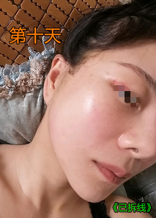 内窥镜拉皮除皱效果,48岁做内窥镜拉皮手术亲身经历