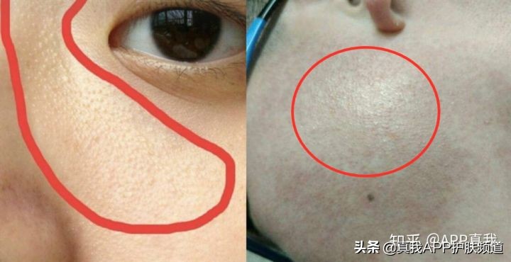 脸上毛周角化长闭口怎么办,毛周角化和粉刺有什么区别