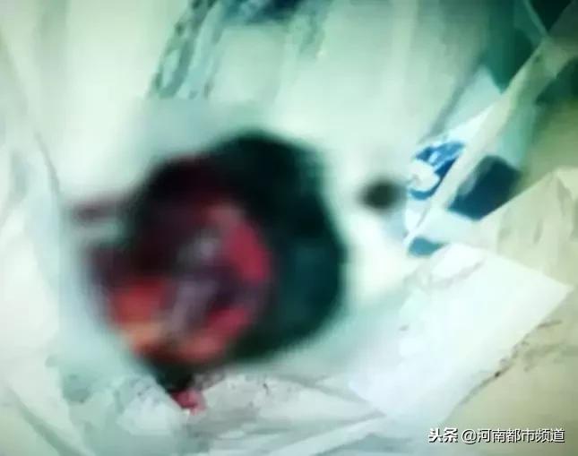 5岁女孩颅底长罕见肿瘤,11岁女孩头部长肿瘤