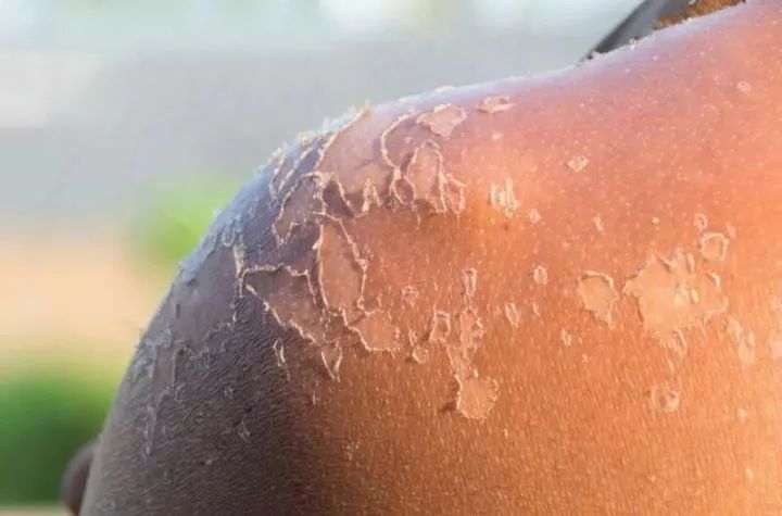 一文击碎芦荟胶完美神话