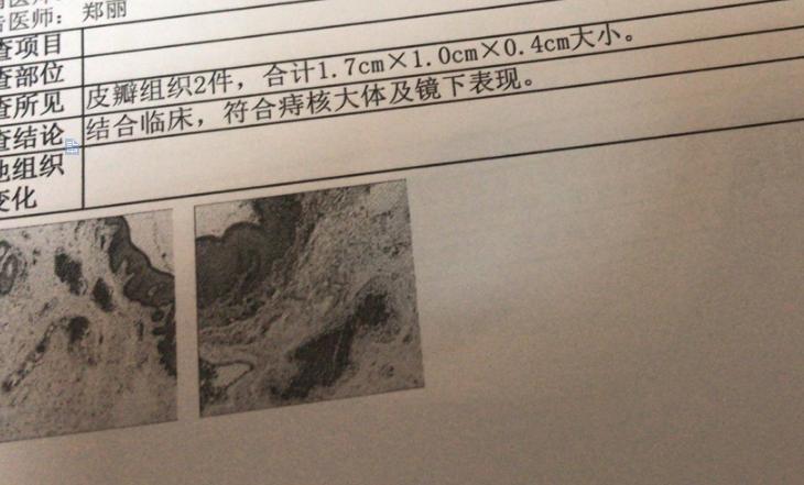 痔疮脱出但能自行恢复,痔疮脱出三年了不痛不痒要怎么治