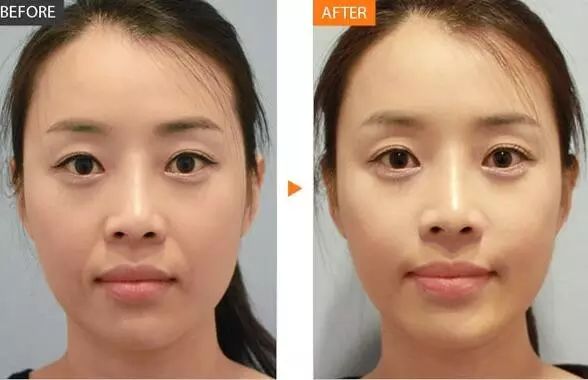 水光针究竟靠不靠谱,水光针究竟怎么选