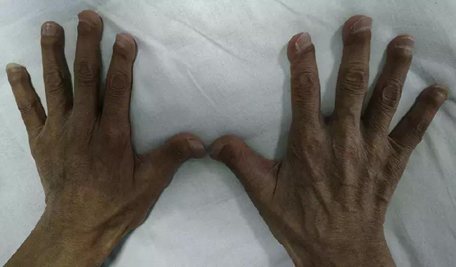 透析病人肌酐急速上升为什么,透析三次肌酐从1100降到500多