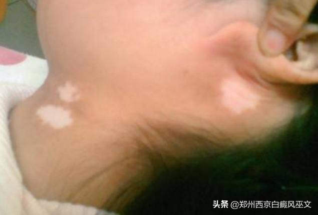 5岁小女孩，家人督促下坚持做这3件事，白癜风逐渐退却