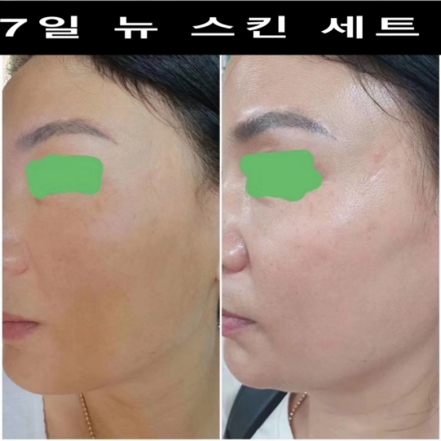 角质层增厚了皮肤好了,角质层健康