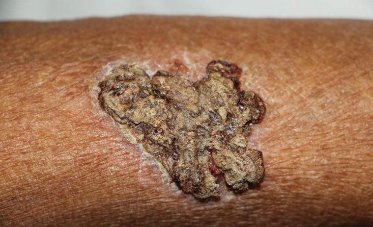 最常见的皮肤癣菌病是哪一种菌,孢子菌感染皮肤病怎样治疗