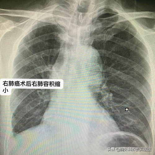 得了食道癌需要戒烟吗,肺癌治疗好了之后发现食管癌