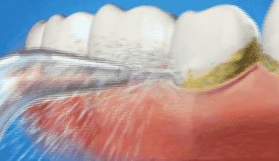 一张嘴就闻到牙臭味怎么办,一张嘴就恶臭怎么回事