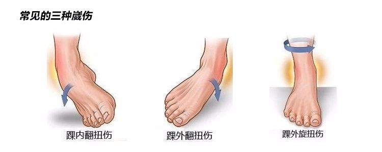 慢性踝关节不稳的康复训练方法,慢性踝关节不稳的康复方法