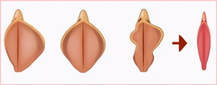 哪些女性需要做私密整形手术？需要注意什么？