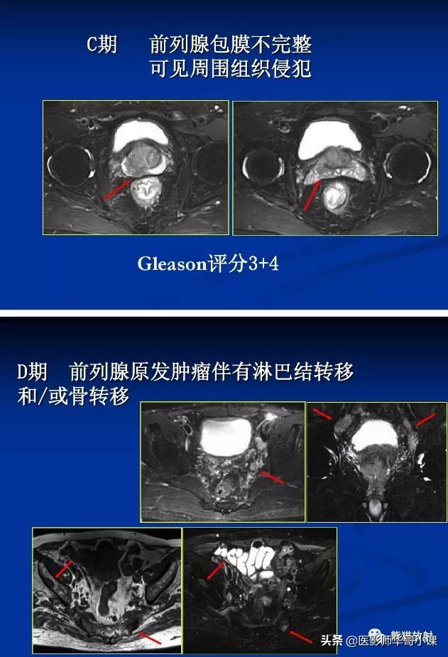 前列腺磁共振影像解剖,前列腺mri正常诊断报告模板