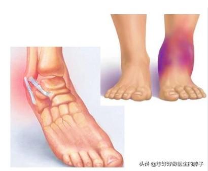 关于踝关节扭伤的正确处理方法,崴脚得重视