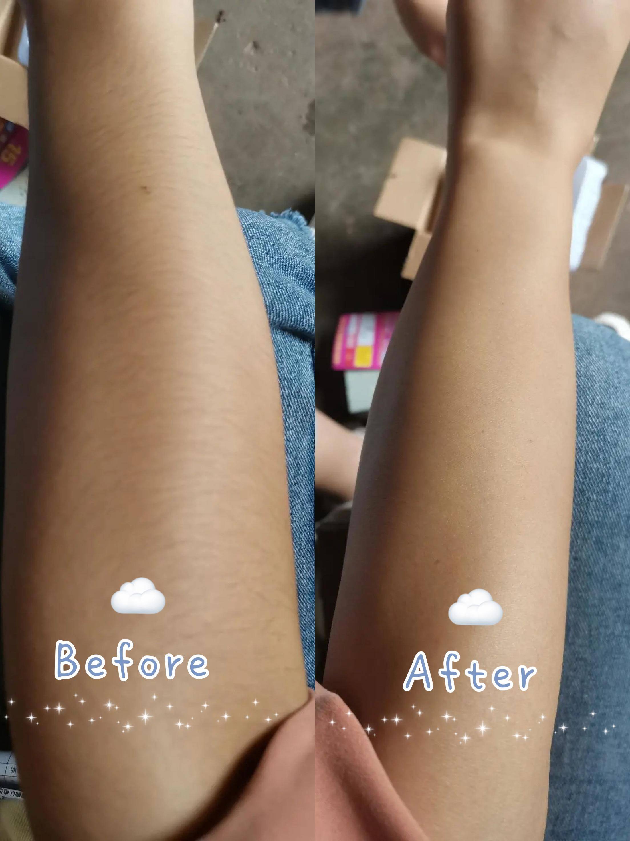 我的脱毛经验分享,我的整容经验分享