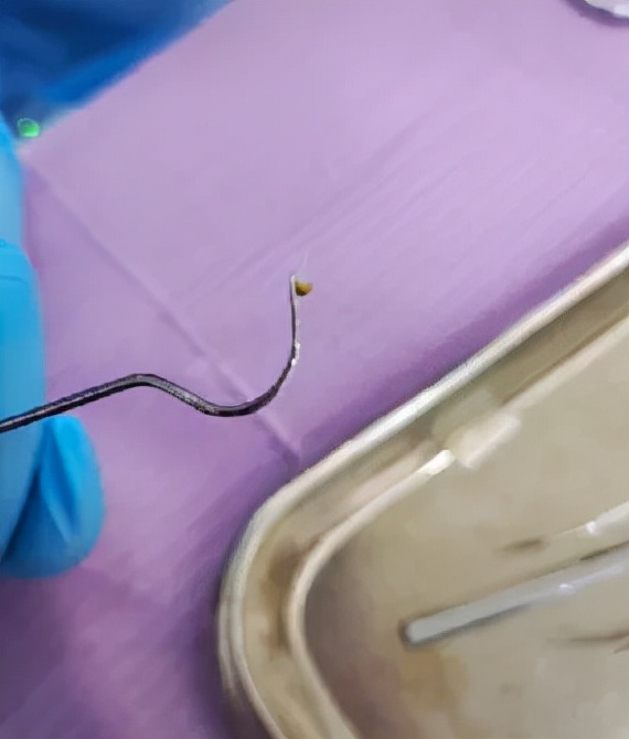 草莓籽在牙缝里为什么会发芽,草莓籽卡牙缝