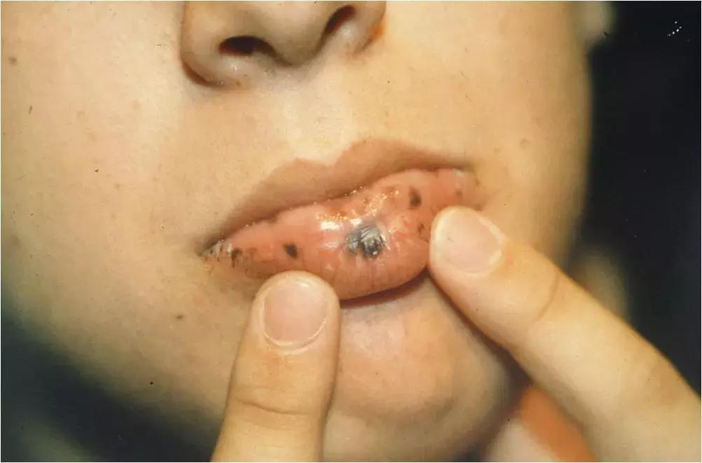 肠内有息肉脸上会长斑吗,有唇斑是肠道息肉吗