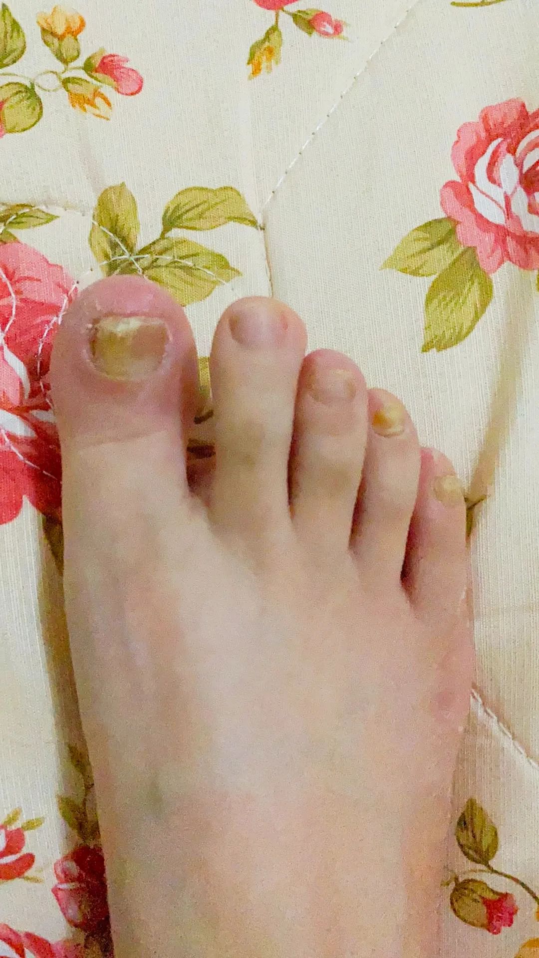 家里治脚气最好的方法,家庭治脚气的最好方法