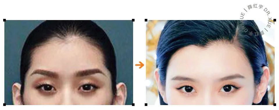 额头饱满跟不饱满一样吗,额头宽太阳穴饱满有什么说法